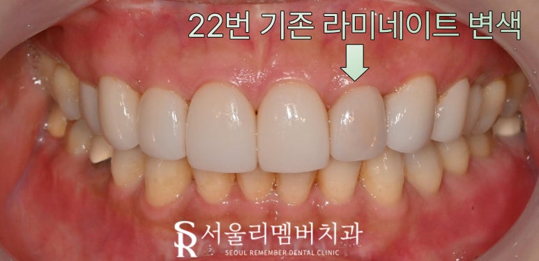 기존 라미네이트 보철 변색 및 송곳니 파절 안쪽으로 이차 우식 생겼을 때 신림역 치과 수면으로 충치치료 리얼네이트 당일 진료 가능할까 관련 이미지 3