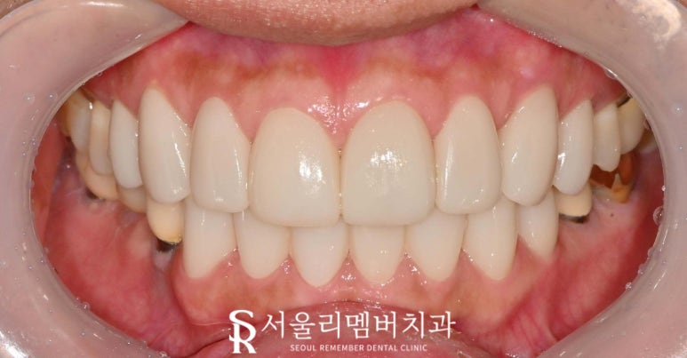 Improving Spaces Between the Front Teeth and Dark Staining from Discolored Resin at the Same Time: Anterior Laminate Veneers and Realnate at Seoul National University Entrance Station Dental Clinic image 3