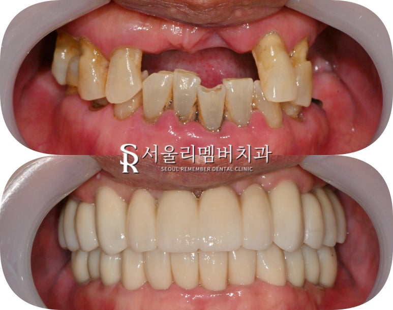 사당 치과 하악 전치 신경치료 브릿지로 살리고 나머지 임플란트로 재건한 전악 증례 관련 이미지 15