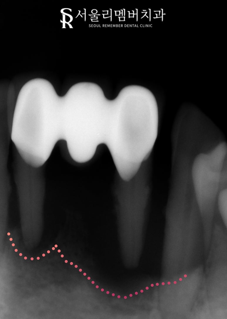 Loose Lower Front Teeth, Sillim Station Dental Clinic, Insurance Anssurge Implant for Patients 65 and Older, Minimal Placement, Lower Cost, Faster Completion image 5