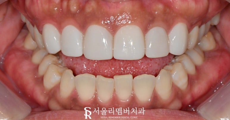 Maxillary Six-Anterior Veneers with RealNate for a Chipped Front Tooth with a Sharp, Rough Edge image 4