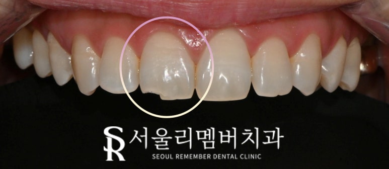 신림 치과 앞니 끝 절단연 깨짐 30분 만에 당일 파절 치아 레진 치료 관련 이미지 2
