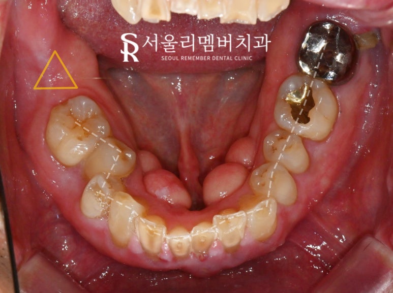 서울대입구역 치과 어금니 상실로 무너진 수직 고경과 과개 교합, 신경치료 크라운과 임플란트로 개선할 수 있다면 관련 이미지 2