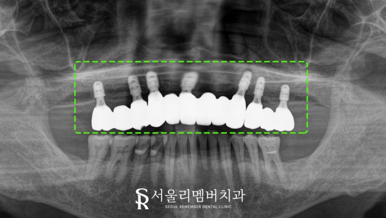 치아가 없을 땐? 서울대입구역 치과 에서 부기 통증 없는 최소절개 전체 디지털 임플란트 치료 관련 이미지 5