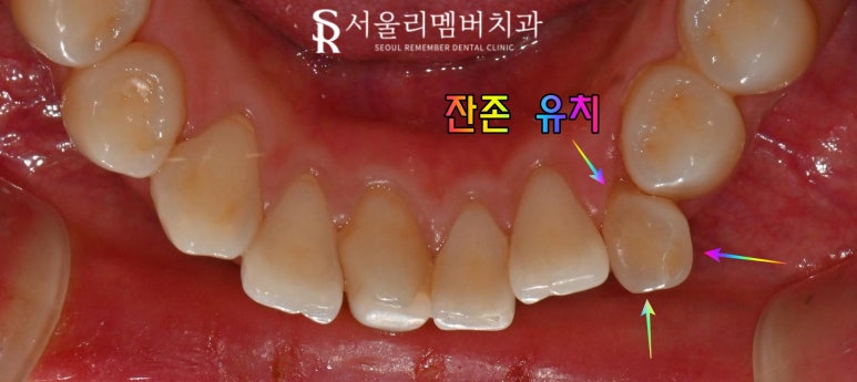 서울대입구역 치과 선천적 영구치 결손으로 잔존 유치 발치 후 브릿지 수복 케이스 관련 이미지 1