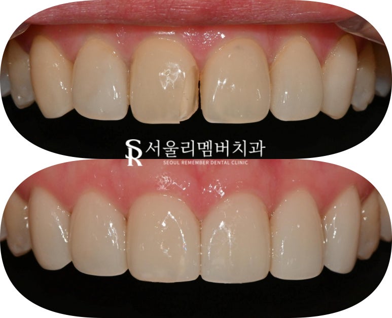 봉천역 치과 파절된 앞니 크라운, 6전치 라미네이트로 심미성 회복하고 환한 미소 되찾기 관련 이미지 3
