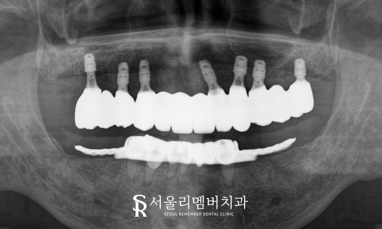 앞니 송곳니 어금니 윗니 전체 임플란트 성공 케이스 "서울대입구역 치과" 관련 이미지 3
