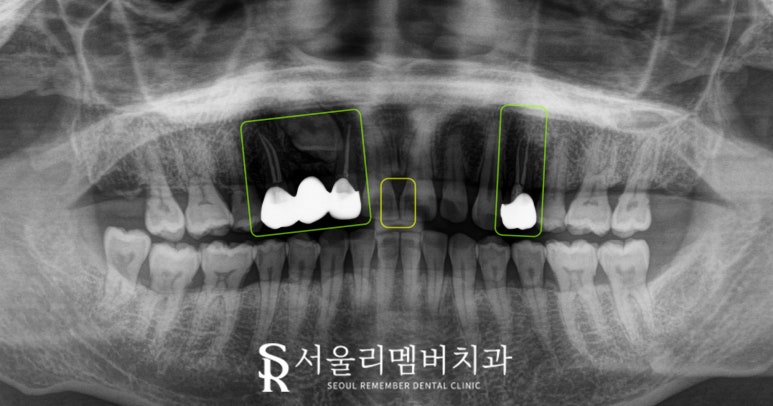 서울대입구 치과 에서 앞니 벌어짐, 변색, 부러지고 통증 있는 치아 레진과 크라운으로 심미 치료 해드린 사례 관련 이미지 4