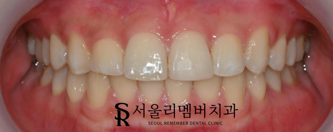 낙성대역 치과 앞니가 깨졌는데 당일 치료 가능할까요? 관련 이미지 3