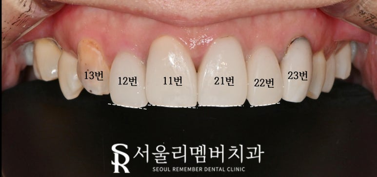 Nakseongdae Dental Clinic: If a front tooth laminate veneer falls off, can’t it just be reattached? Anterior crowns and Realnate re-prosthetics image 2