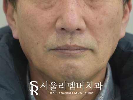 오래된 보철을 방치하면 결국 임플란트 식립밖에 남지 않게 됩니다! 봉천역 리멤버 치과 관련 이미지 11
