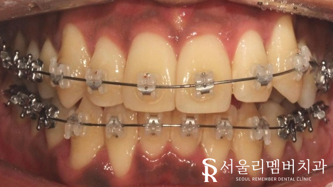 서울대입구역 치과 에서 들쑥날쑥 했던 치열, 비발치로 개선해 드렸습니다. 관련 이미지 4