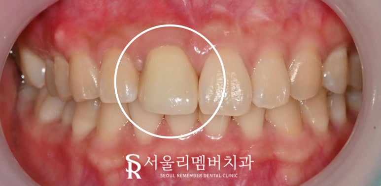서울대입구역 치과 앞니 임플란트 보철 디자인 생김새 모양 마음에 안 들 때 수정할 수 있을까? 관련 이미지 3