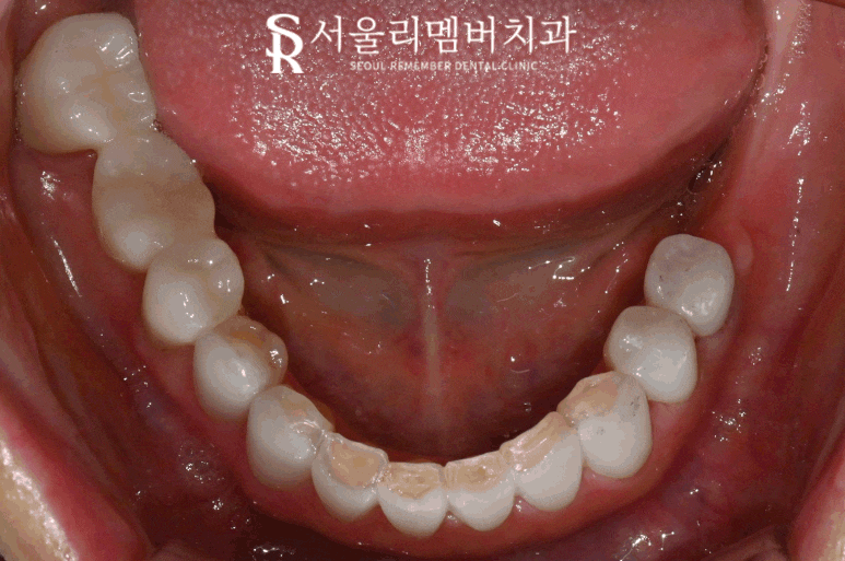 서울대입구역 치과 에서 오래된 어금니 브릿지 지르코니아 크라운 으로 교체해서 심미성 되찾아드렸습니다. 관련 이미지 4