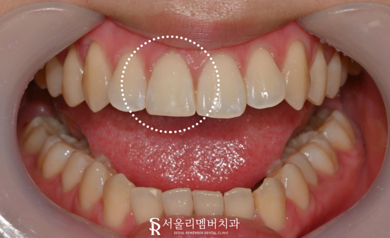 사당역 치과 깨진 앞니, 당일 레진 수복으로 비용 부담 없이 하루 만에 가능 관련 이미지 2