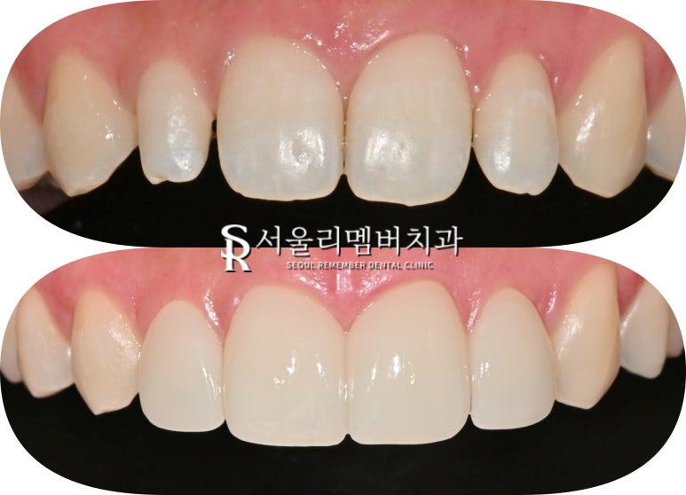 치아 크기 작은 왜소 측절치, 봉천동 치과 전치부 라미네이트로 자연치 삭제 없이 리얼하게 개선하는 방법 관련 이미지 5