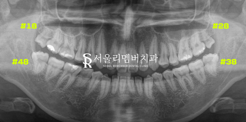 사당역 치과 사랑니 발치 시 이곳을 조심해야 됩니다! (하치조신경/상악동) 관련 이미지 1