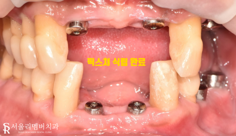 치석이 발치로 이어질 수 있다는 말, 사실일까요?! 봉천동 서울 리멤버 치과 관련 이미지 6