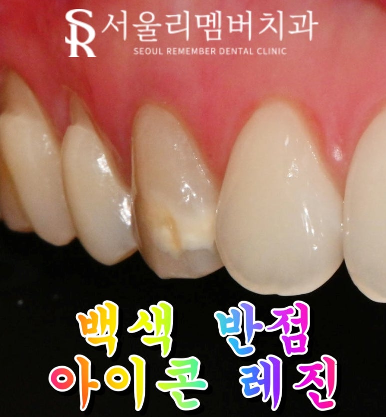 치아의 하얀 반점(화이트 스팟 white spot) 서울대입구역 치과 아이콘 레진으로 무삭제 반점치 충치 치료 관련 이미지 5