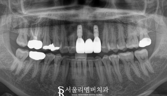 신림역 치과 염증으로 흔들리는 앞니, 심미적인 전치부 임플란트 식립 증례 관련 이미지 4