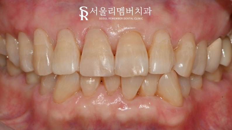 봉천역 치과 깨진 앞니와 치경부 마모, 레진 당일 수복 증례 관련 이미지 3