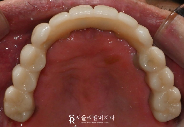서울대입구역 양심 치과, 최소 비용으로 전체 임플란트 수술 관련 이미지 6