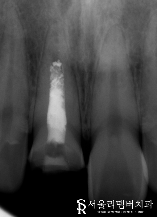 전치부 신경치료 과정과 주의사항은? (post&core) 영등포동 치과 관련 이미지 3