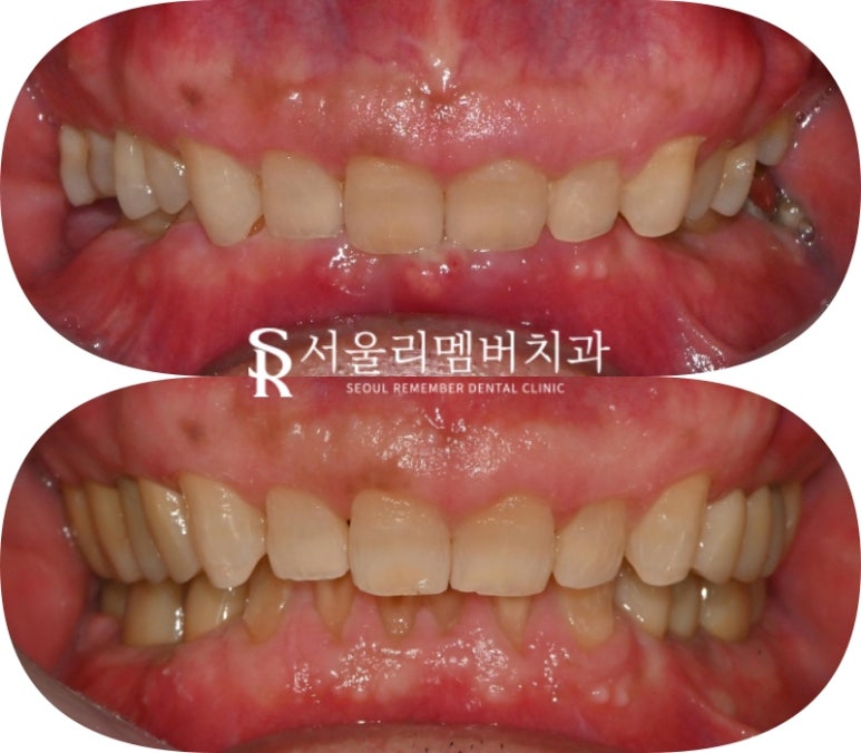 서울대입구역 치과 어금니 상실로 무너진 수직 고경과 과개 교합, 신경치료 크라운과 임플란트로 개선할 수 있다면 관련 이미지 8