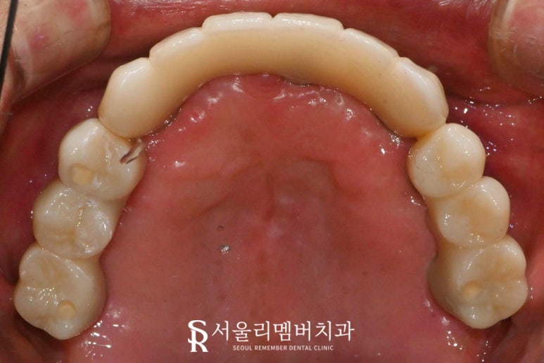 서울대입구역 치과 치아가 하나도 없는 무치악 환자를 위한 최소 비용 풀아치 임플란트 관련 이미지 5