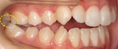 조기접촉 교정 전 관련 이미지 2