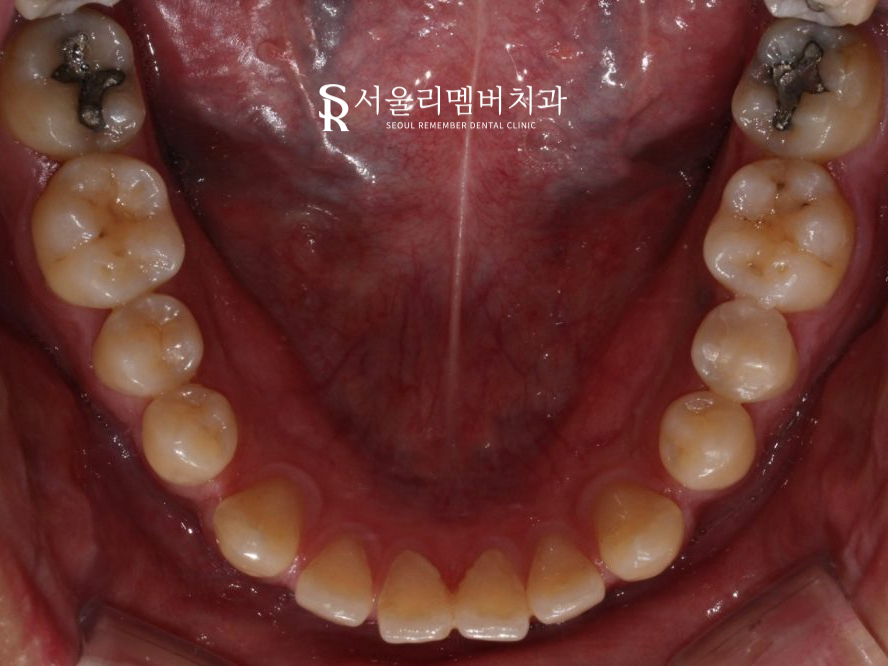 벌어진 치아, 사당 치과 인비절라인으로 개선할 수 있을까? 관련 이미지 6