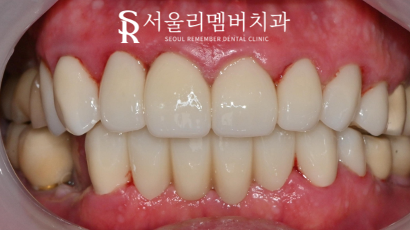 색이 변하고 약해진 치아들, 서울대입구역치과 에서 앞니 보철 수복으로 개선을 도와드렸습니다. 관련 이미지 2
