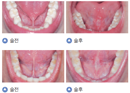 혀가 짧다? 설소대 절제술로 해결할 수 있습니다. 봉천동 치과 관련 이미지 2