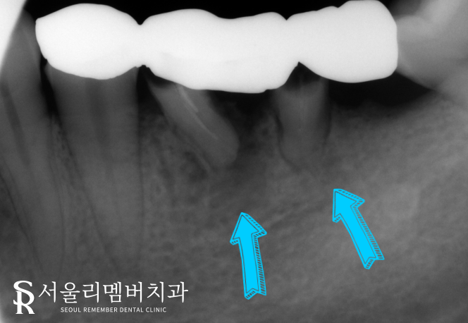 기존 브릿지 주변이 욱신거리고 아파요.. 왜 그런 걸까요? 신대방 치과 임플란트 증례 관련 이미지 2