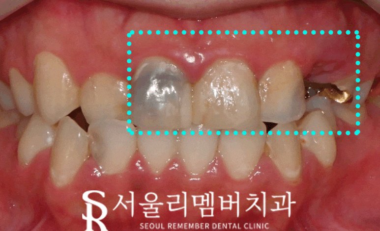 신대방 치과 "처음에는 작은 충치, 나중에는 치아 발치?" 앞니 임플란트 및 신경치료 후기 관련 이미지 1