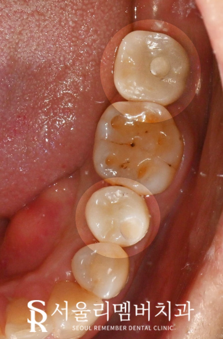신림 치과 만 65세 이상 보험 임플란트 가격, 비용, 기간, 뼈이식, 크라운 종류 관련 이미지 4