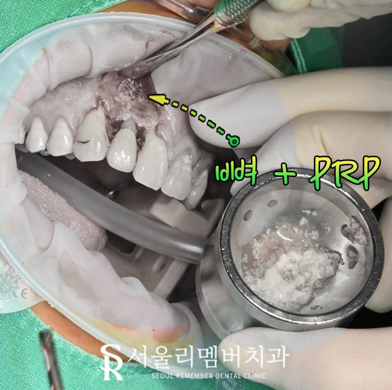 앞니 뿌리 끝 염증, 치근단 절제술(apicoectomy) 보라매 치과 관련 이미지 6