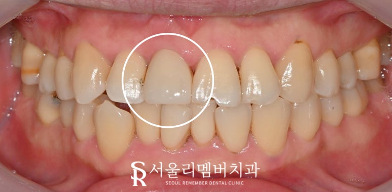 사당 치과 치수 침범 치관 파절로 부러진 앞니 당일 신경치료 후 크라운 관련 이미지 3