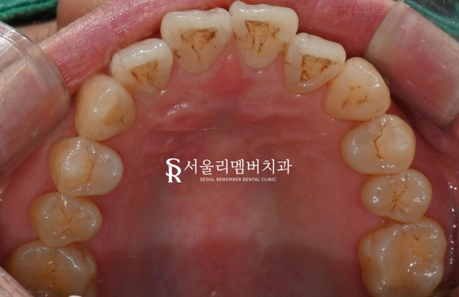 서울대입구역 치과 이렇게만 해도 치아 수명을 늘릴 수 있습니다 관련 이미지 3