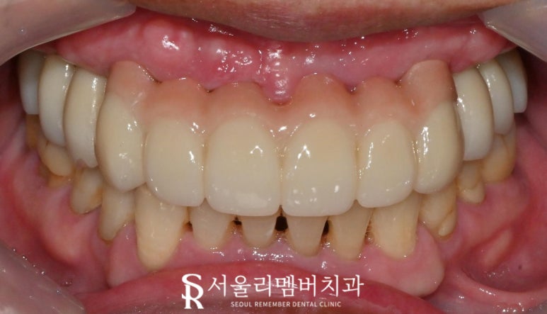 치아가 없을 땐? 서울대입구역 치과 에서 부기 통증 없는 최소절개 전체 디지털 임플란트 치료 관련 이미지 6