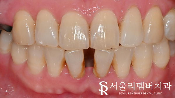 보라매역 치과 신경치료 및 크라운으로 기능과 외관 되살리기. 관련 이미지 1