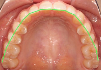 조기접촉 교정 후 관련 이미지 4