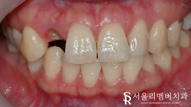 어? 전에 올려놨던 앞니 크라운이 갑자기 떨어졌어요 ! 신길동 치과 관련 이미지 1