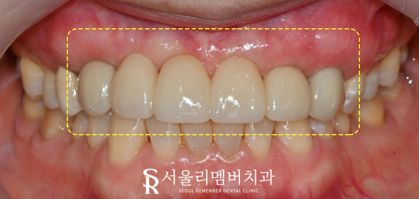 상악 전치부 임플란트 후 고퀄리티 심미보철 로 자신감 되찾으세요! 관련 이미지 4