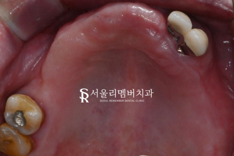 서울대입구역 치과 나에게 맞는 보철은 틀니? 임플란트? 관련 이미지 2