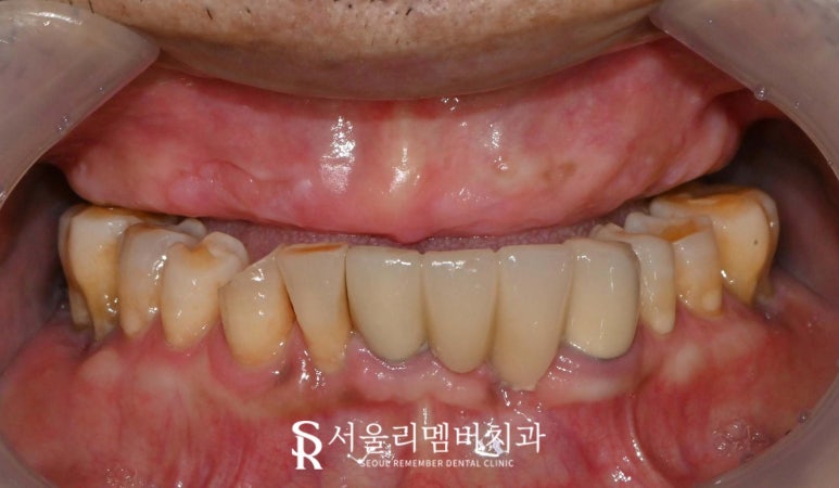 서울대입구역 치과 치아가 하나도 없는 무치악 환자를 위한 최소 비용 풀아치 임플란트 관련 이미지 2