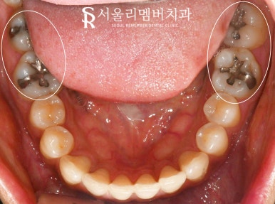오래된 아말감 신림 치과 수면(의식하 진정) 마취 후 스트라우만 나이스 인레이로 교체 (좌우 2회로 나누어 진행 가능) 관련 이미지 3