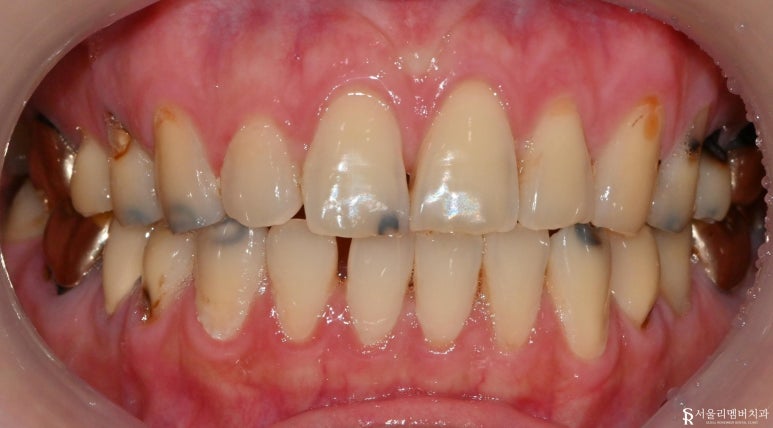 곳곳에 많은 충치, 신림역 치과 에서 앞니 심미 레진 치료와 어금니 지르코니아 크라운 치료 관련 이미지 1