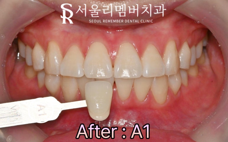 신림 치과 웨딩촬영 결혼 행사 앞두고 신경 쓰이는 누런 치아 하루 만에 밝게 만들 수 있을까? 관련 이미지 3