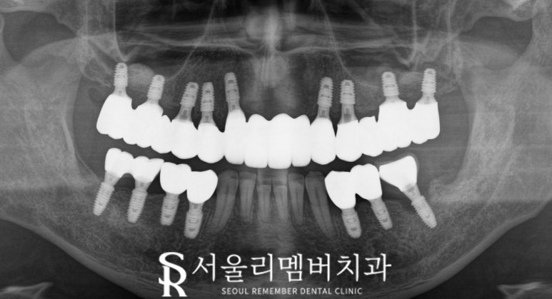 서울대입구역 치과 "부분틀니에서 임플란트로" 바꿔서 전악 개선해 드린 증례 관련 이미지 6